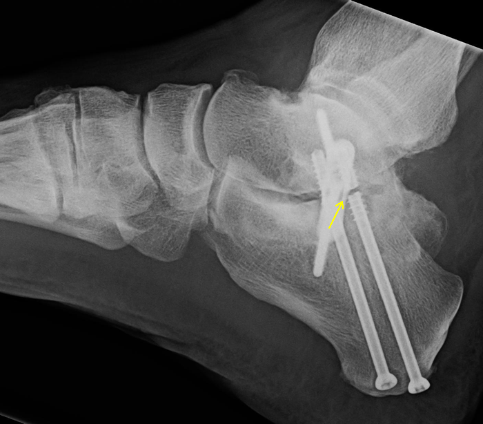 Case 1 Lateral XRay